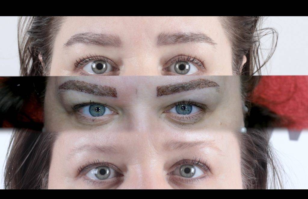 Micro Brow Implant Nedir? 