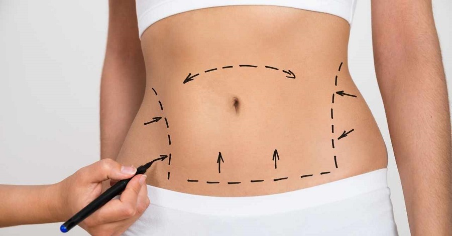 Karın Germe Ameliyatı – BSHA